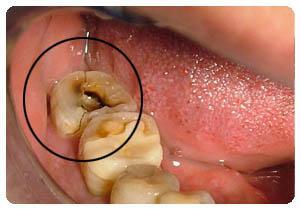 口腔和牙齿疾病的发病率如何