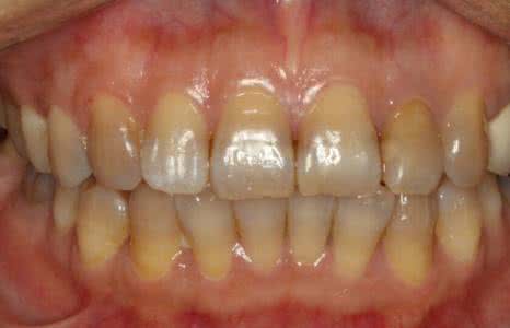 四环素牙的发病机制及临床表现