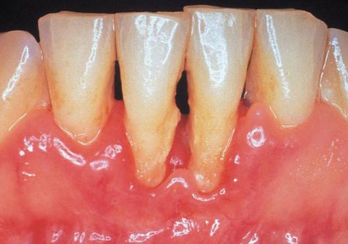 引起牙齿松动的原因是什么