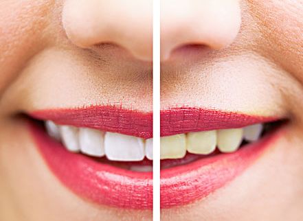 一般常见的牙齿异常着色的原因是什么