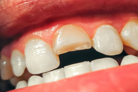 理想的牙体修复材料应具备的性能