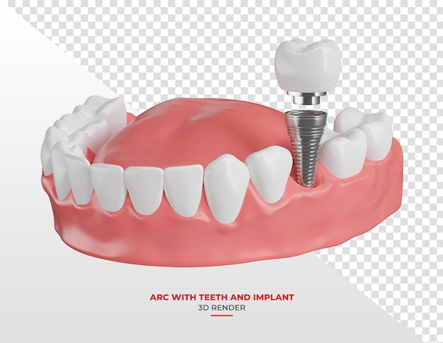 韩国sg种植牙和韩国登腾种植牙的价格和区别？该如何选择？