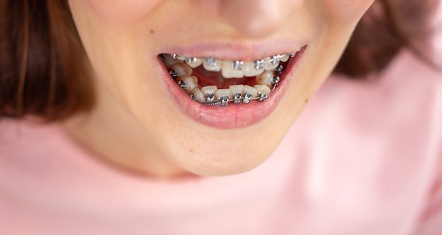 整牙齿矫正多少钱？22岁牙齿咬合不对称能矫正好吗？