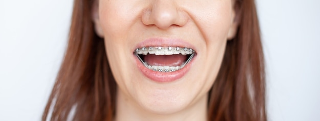 矫正牙齿要拔牙4颗有危害吗？矫正牙齿可以先矫正后拔牙吗？
