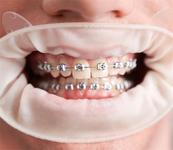 为什么许多人选择种植牙？口腔修复新趋势解析