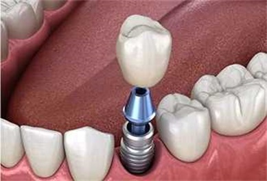 种植牙品牌排行榜有哪些？十大种植牙系统品牌推荐