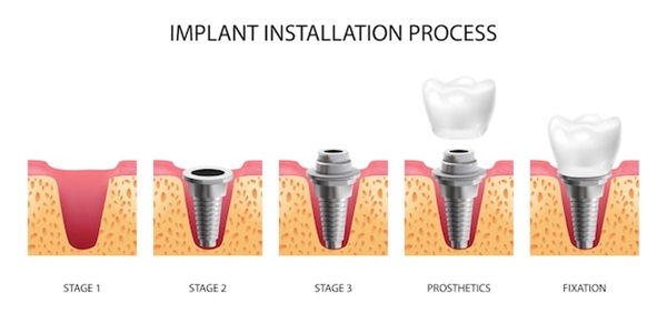 韩国美格真种植牙使用寿命多少年？多少钱一颗？