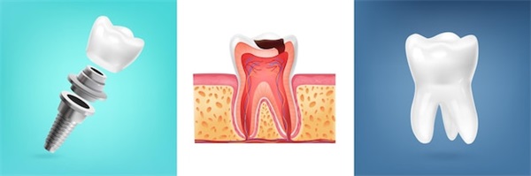 60歲老人牙齒脫落鑲牙和種植牙哪個较好？