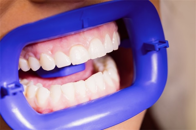 种植牙后如何保养牙齿、牙龈和舌头？几点很重要