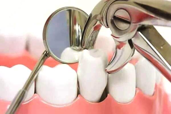 智齿发黑烂了怎么办，智齿问题的识别与处理