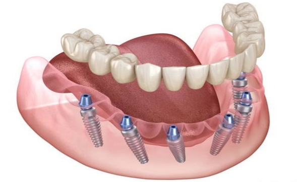 种植牙术前如何进行口腔检查？种植牙的成功率受哪些因素影响？