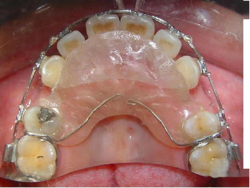矫正牙齿前有需要注意的吗？牙齿矫正器有哪些材质？