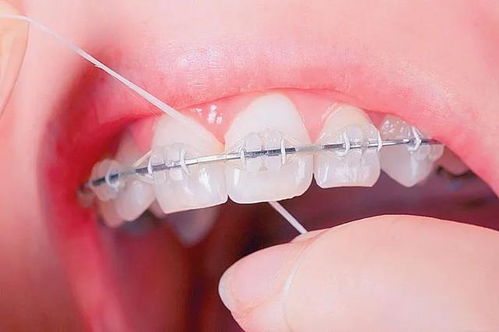 矫正牙齿时牙齿总出血怎么办？牙齿矫正怎么清理牙齿？