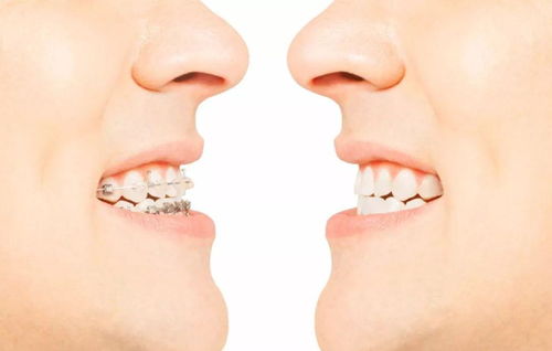 传统矫正vs隐形矫正的区别，各自有什么优缺点？