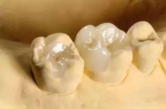 树脂牙和烤瓷牙的区别是什么？怎么选择补牙的材料？