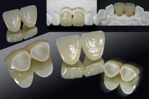 牙科小知识：烤瓷牙和树脂牙的使用寿命探究