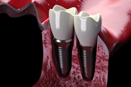 老年人种植牙好吗？老年人种牙会有哪些风险？