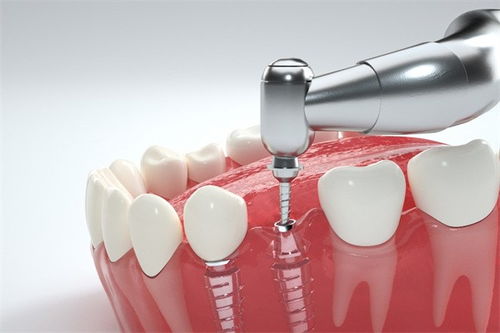 能拔完牙立即种牙吗？即刻种植的适应人群有哪些？