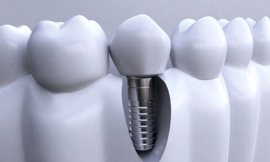  种植牙的恢复期需要注意哪些问题？老年人种牙后如何保持口腔健康？