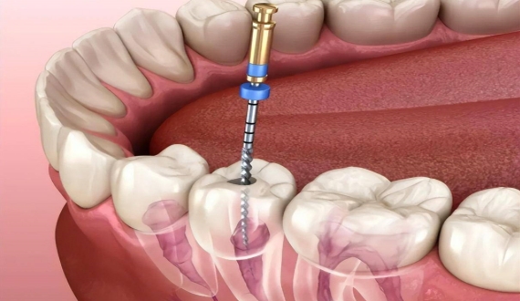 牙科知识：哪些情况下补牙后需要进行根管治疗？
