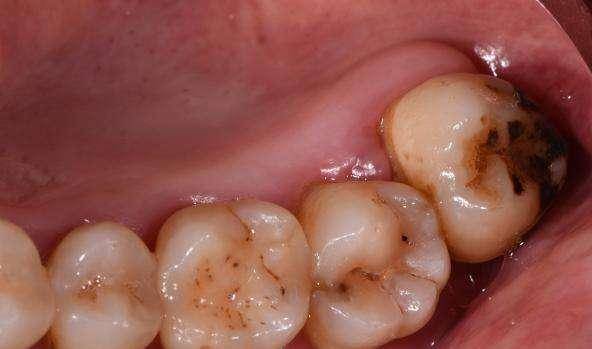 死髓牙要拔掉吗?如何判断牙髓是否坏死？