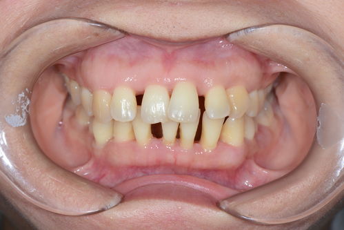 牙齿太稀要怎么矫正？牙齿稀疏矫正需要先种牙吗？