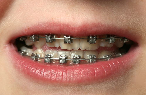 牙齿深覆合好矫正吗？牙齿深覆合需要手术吗？