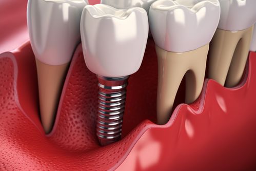 种植牙过程会痛苦吗？种植牙适合中老年人吗？