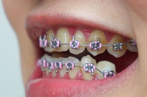 为什么要拔掉好的牙齿做矫正？骨性牙要怎么矫正？