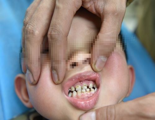 孩子地包天是怎么造成的？儿童地包天牙齿要怎么矫正？