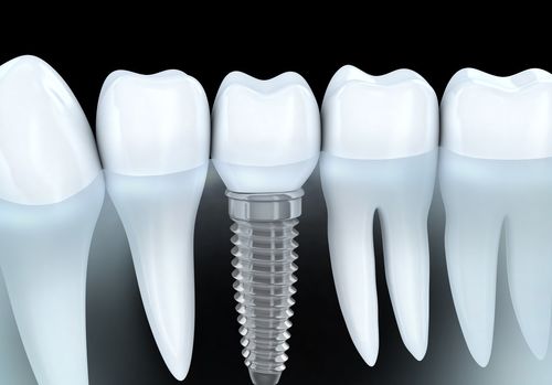 种植牙会有后遗症吗？种植牙失败后多久可以重新种植？