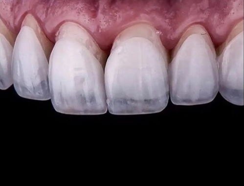 牙齿贴面有哪些类型？牙齿贴面对牙齿会有危害吗？