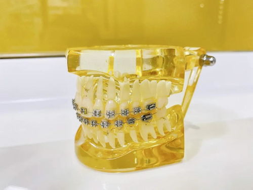 矫正牙齿的牙槽会脱落吗？牙槽脱落该怎么办？