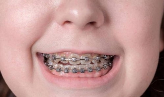 牙齿矫正挂皮筋有什么注意事项？青少年牙齿矫正的常见问题有哪些？