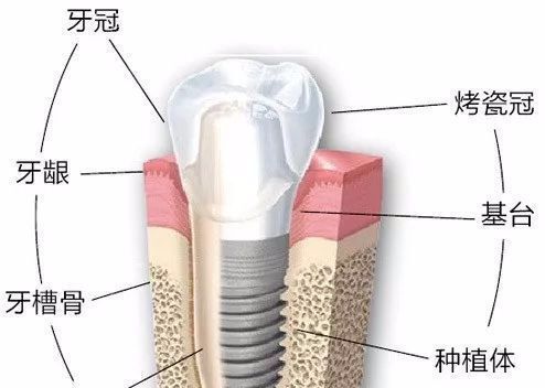 选择种植牙医院有什么技巧？种植牙医生技术重要吗？
