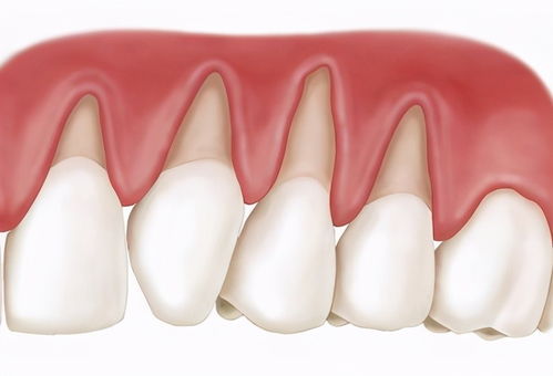 烤瓷牙多久需要更换？烤瓷牙松动了要怎么固定？