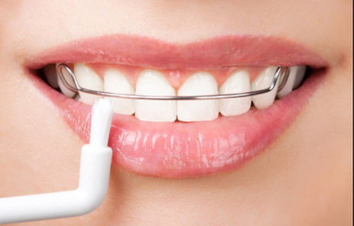 为什么正畸后需要佩戴保持器？正畸后有哪些方法可以保持口腔清洁？