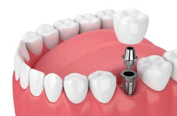 牙科小知识：种植牙和传统假牙的优缺点有哪些？