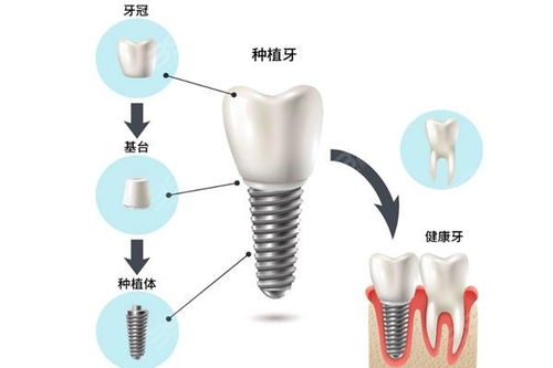种牙小知识：种植牙术后感染会影响种植牙的使用寿命吗？