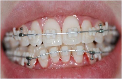 有哪些儿童牙齿不齐的治疗方法？儿童矫正牙齿时有哪些注意事项？