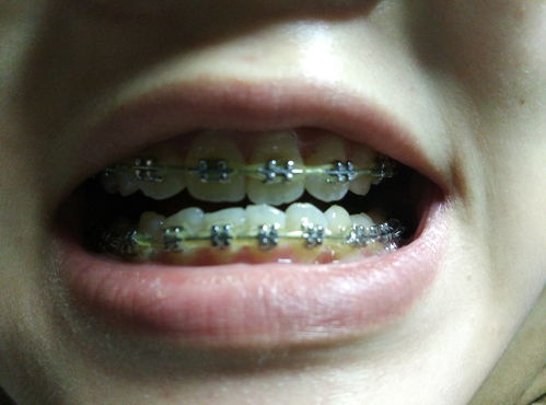 正畸小知识：牙齿矫正时如何引导孩子养成良好的口腔卫生习惯？