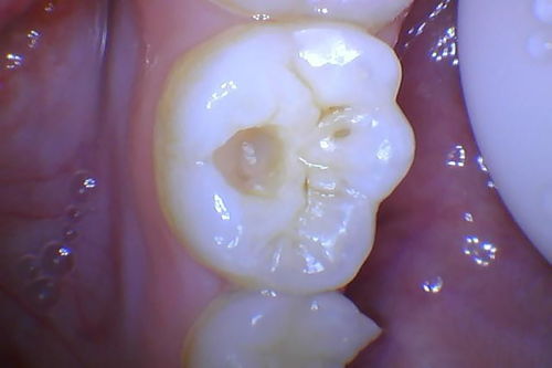 龋齿轻微疼痛需要做根管吗？龋齿到什么程度需要做根管治疗？