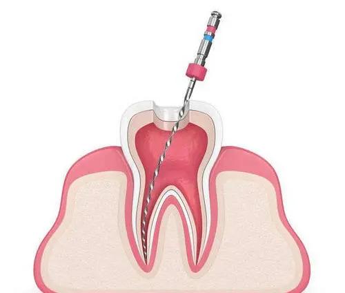 哪些因素会影响根管治疗的效果？根管治疗一般需要多长时间？