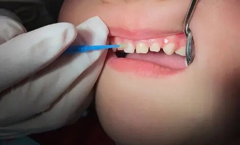 怎么爱护儿童的牙齿？儿童补牙有哪些需要注意的？