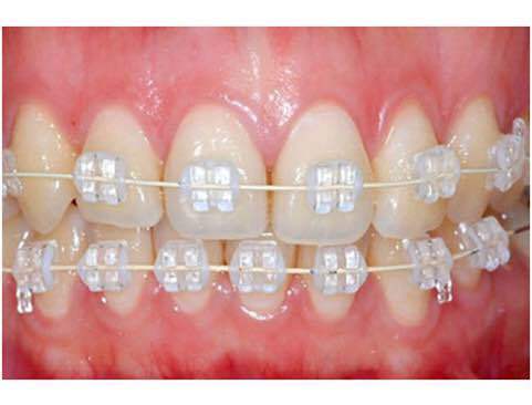 正畸小知识：牙龈炎症会影响牙齿矫正的效果吗？