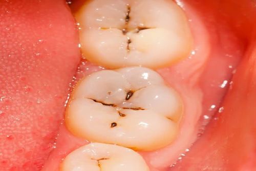 为什么牙齿没有洞也会痛？龋齿的治疗过程痛苦吗？