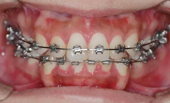 埋藏牙矫正有哪些利弊？怎么判断自己的错颌畸形严不严重？