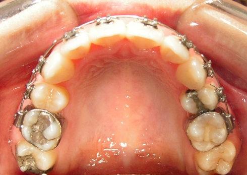 错颌畸形中哪些因素是可以避免的？哪些口腔习惯可能导致错颌畸形？