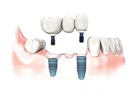 口腔种植术后如何保持口腔卫生？种植牙齿后使用期限是多久？