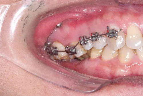 牙科小知识：牙根吸收会对牙齿的健康产生哪些影响？